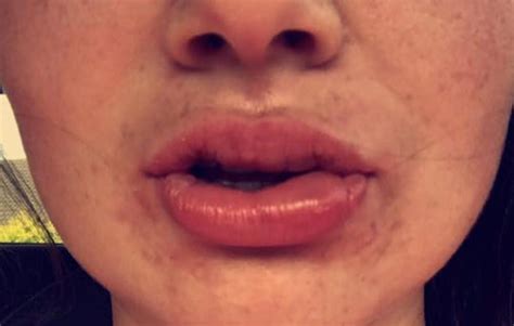 are swollen lips serious