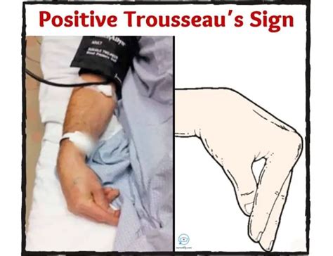 Trousseau S Sign Causes Assessment Treatment Nurseship