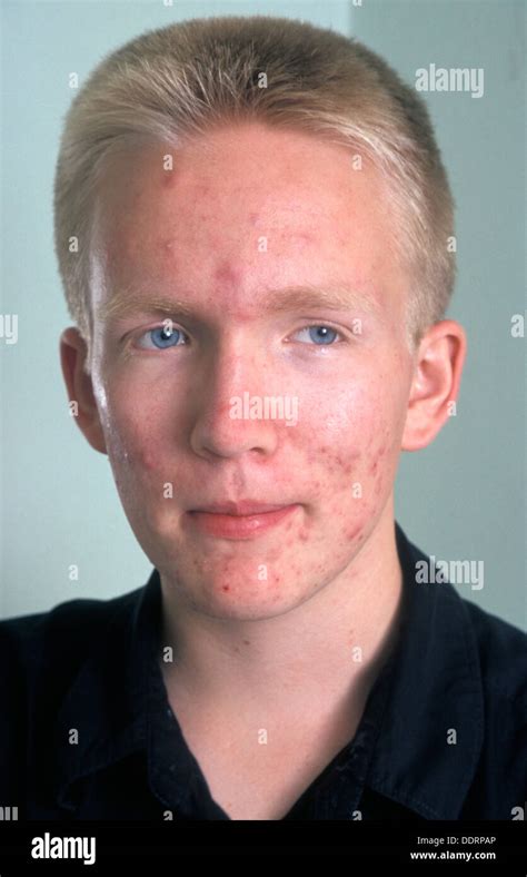 Portrait Teenage Boy Acne Hi Res Stock Photography And Images Alamy