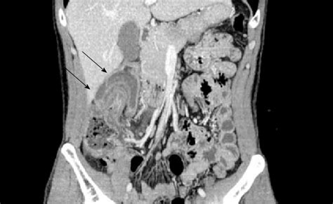 Abdominal Contrast Enhanced Computed Tomography Ct Imaging The
