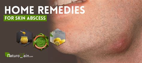 8 Safe And Best Home Remedies For Skin Abscess