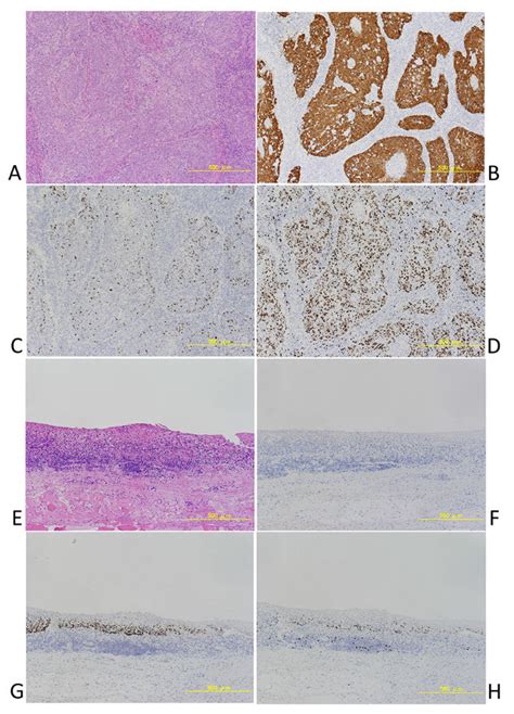 A D A Case Of P16 Positive Squamous Cell Carcinoma Of Oropharynx A
