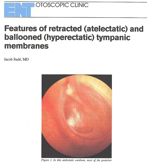 Figure 1 From Features Of Retracted Atelectatic And Ballooned
