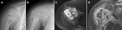Rapid Progression Of A Proximal Humeral Aneurysmal Bone Cyst From A
