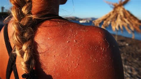 7 Skin Cancer Warning Signs You Should Never Ignore Artofit