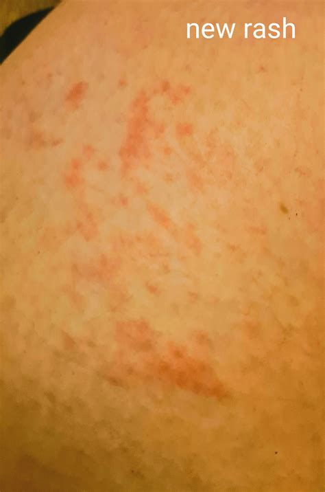 Psoriasis Or Ringworm Symptoms Treatment And Other Rashes Zohal