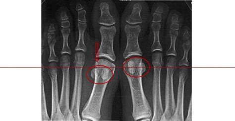 Turf Toe o alluce da tappeto erboso: una lesione ...