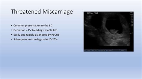 Pv Bleeding In Early Pregnancy And Threatened Miscarriage Youtube