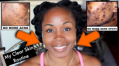 Get Rid Of Acne Scars Dark Spots And Hyperpigmentation