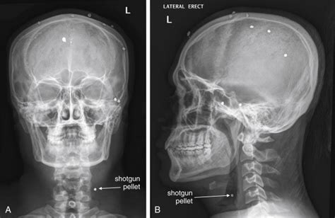 Imaging Soft Tissues Of The Neck Radiology Key