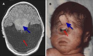 Holoprosencephaly Causes Diagnosis Prognosis And Treatment