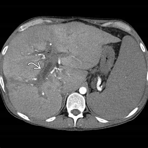 Primary Sclerosing Cholangitis Radiology Key