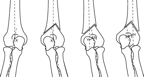 Reverse V Osteotomy Of The Distal Humerus For The Correction Of Cubitus