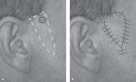 Local And Regional Flaps For Head And Neck Reconstruction Plastic