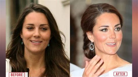 Kate Middleton Had Undergone Plastic Surgery Does Kate Use Botox
