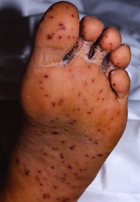 Measles Causes Rash Symptoms Signs Measles Treatment