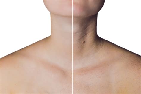 Botox For Neck New Skin Laser Center