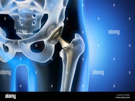 Artificial Hip Joint Closeup 3d Illustration Stock Photo Alamy