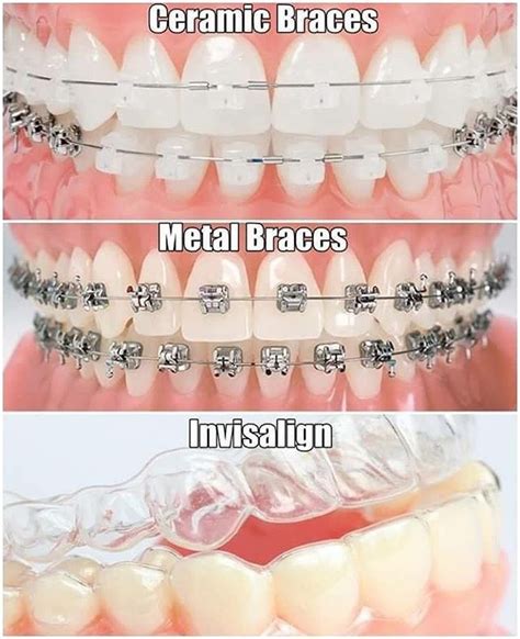 All Types Of Braces Available At Kdc Call Us On 021 6969428 For More