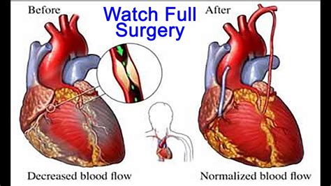 Minimally Invasive Coronary Artery Surgery Micas By Dr Yugal K Mishra