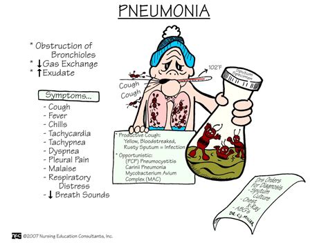 Pneumonia Nursing Mnemonics And Tips Nursing Mnemonics Surgical