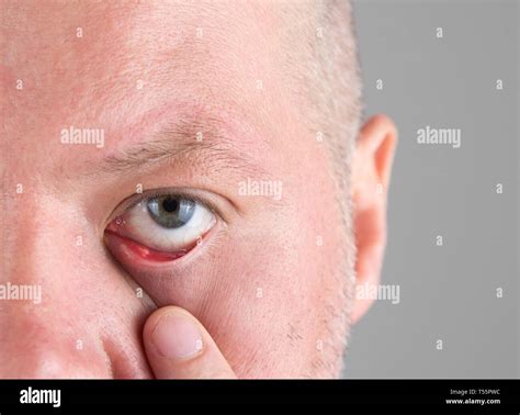 Close Up Of Stye In The Eye At The Lower Eyelid Hordeolum Or Chalazion