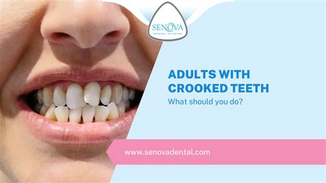 Adults With Crooked Teeth What Should You Do Senova Blog