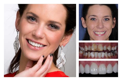 Smile Makeover Guide All You Need To Know About Composite Veneers