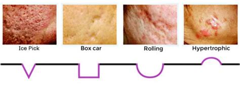 Scar Types Skin By Design Dermatology And Laser Center Pa