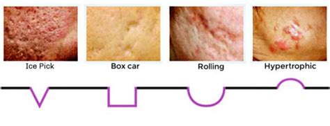 According to the american academy of dermatology, approximately 50 million americans struggle with acne each year. Scars & Stretch Marks - Skin by Design Dermatology & Laser ...