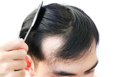 How To Stop Early Stages Of Baldness And Thinning Hair The Male