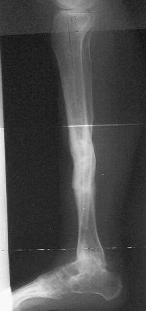 A Lateral X Ray Showing A Recurvatum Malunion Of The Tibial Shaft