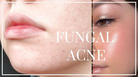Fungal acne is usually resistant to traditional acne treatments, but can be successfully reduced with the right body washes and oral medication. How to Get Rid of Fungal Acne // BEAT TINY BUMPS - YouTube