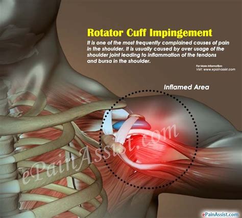 Rotator Cuff Tendonitis And Impingement Syndrome Treatment My Xxx Hot Girl