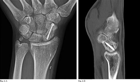 Figure 6 From Free Vascularized Medial Femoral Condyle Bone Graft After