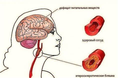 Низкохолестериновая диета при атеросклерозе