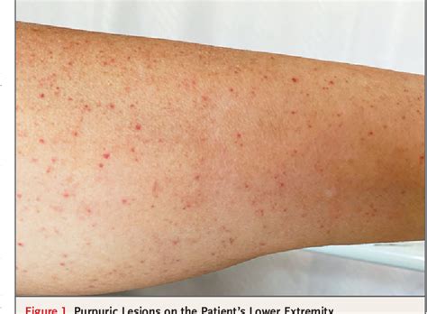 Figure 1 From Immune Thrombocytopenic Purpura In A Patient With Covid