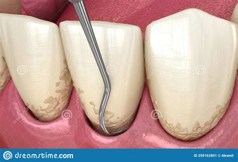 Closed Curettage Scaling And Root Planing Conventional Periodontal