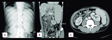 A Abdominal Radiology Revealed An Enlarged Spleen 23 Cm B C