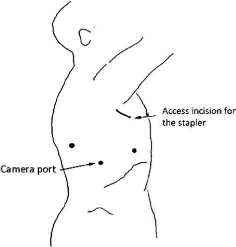 Thoracoscopic Approach Port Placement A 5 Mm Port That Accommodates