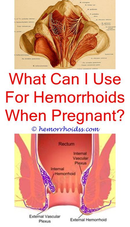Pin On Hemorrhoids Cure