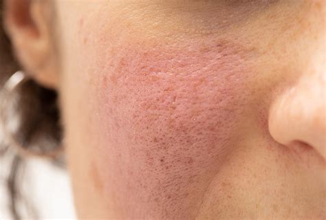 Redness On Face After Applying Ice Causes Tips To Prevent It