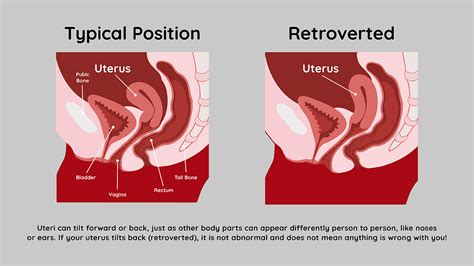 Retroverted Uterus Cervix Position