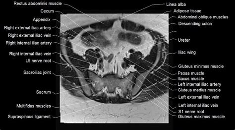 Mri Female Pelvis Anatomy Axial Image Pelvis Anatomy Rectus Abdominis Muscle Pelvis