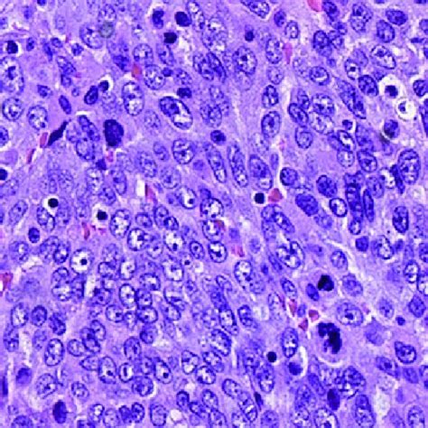 High Grade Serous Carcinoma With Very Atypical Epithelial Cells With