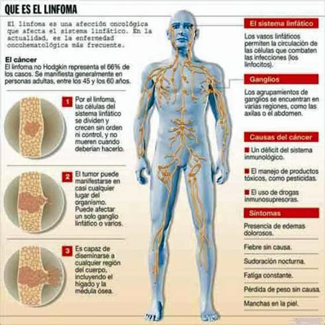 Linfoma no Hodgkin Enciclopedia Médica Ferato