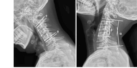 Cervical Flexionextension Lateral Radiographs Obtained After A