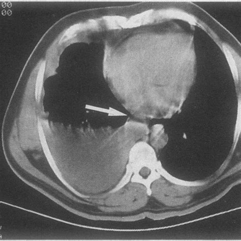 Computed Tomogram Showing The Hydatid Cyst Arrow In Liver And Pleural