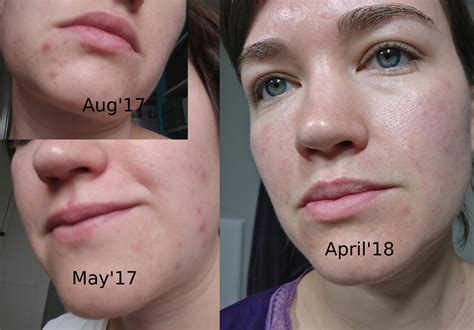 Banda Skin Concerns How I Treated My Non Fungal Acne With Antifungal