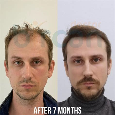 Before After Dr G Khan Bircan